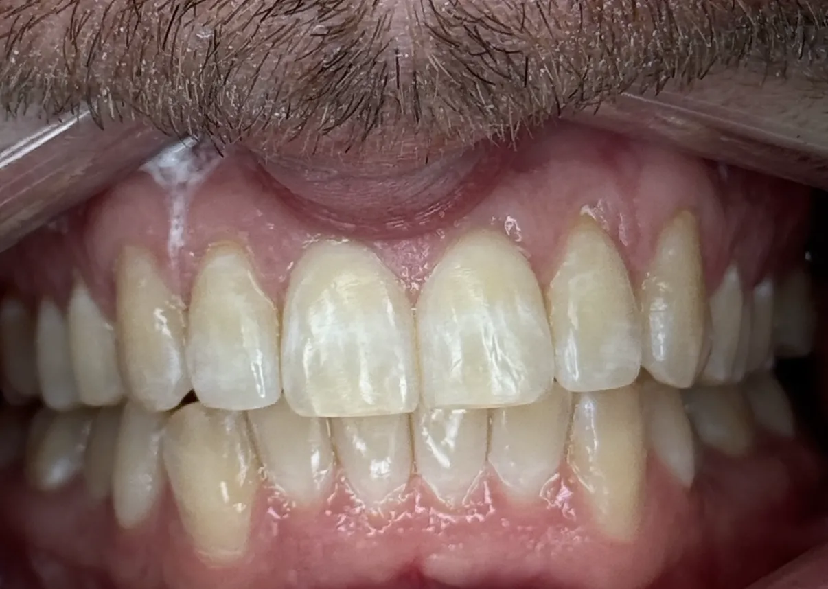 Patient close-up smile after Invisalign treatment