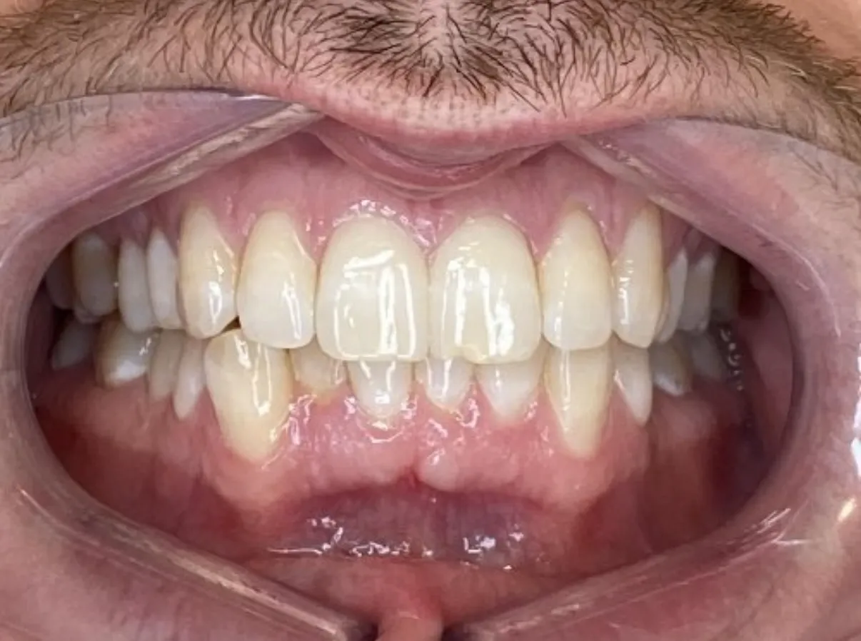 Patient close-up smile before Invisalign treatment