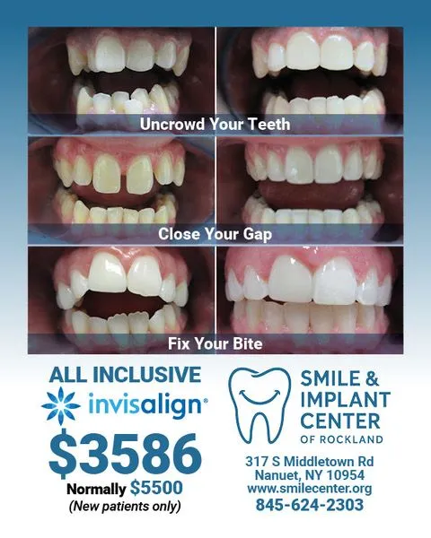 All Inclusive Invisalign $3586 - Normally $5500 - New patients only - Smile and Implant Center of Rockland